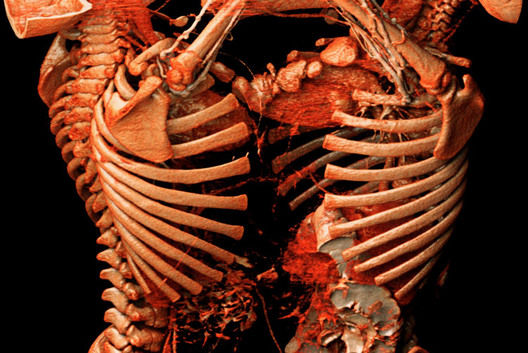 Rib cage in Anatomage table view