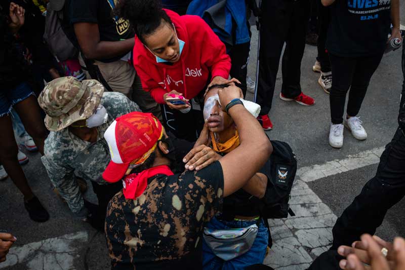 Medic pouring milk over a young girl's eye